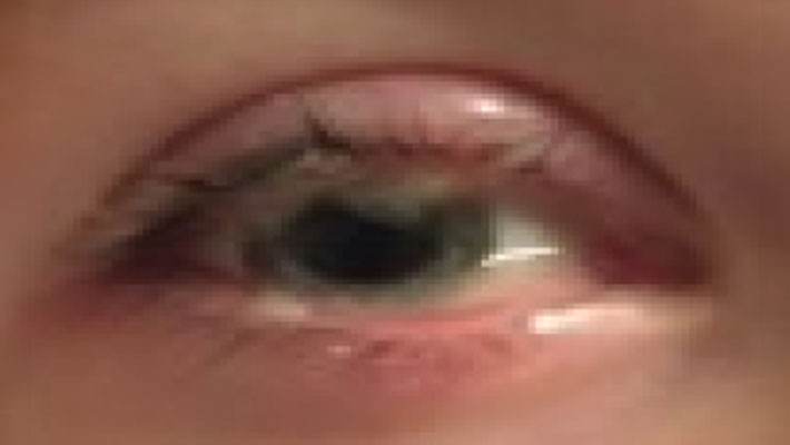 Early stage ligneous conjunctivitis presenting as pseudomembranous conjunctivitis