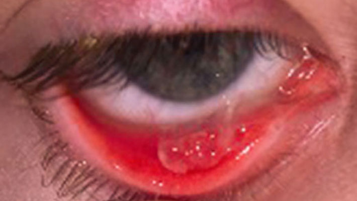 Middle stage ligneous conjunctivitis presenting as a clear palpebral conjunctival lesion