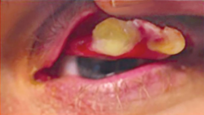 Advanced stage ligneous conjunctivitis presenting as a wood-like palpebral conjunctival mass